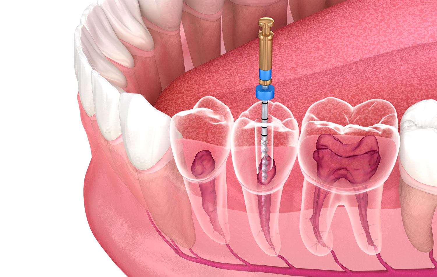 ecuador-dental-care-Endodontics-1